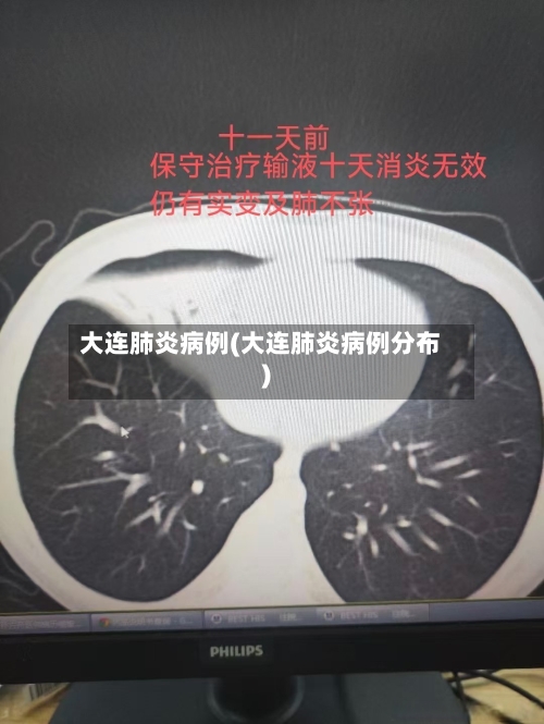 大连肺炎病例(大连肺炎病例分布)-第2张图片