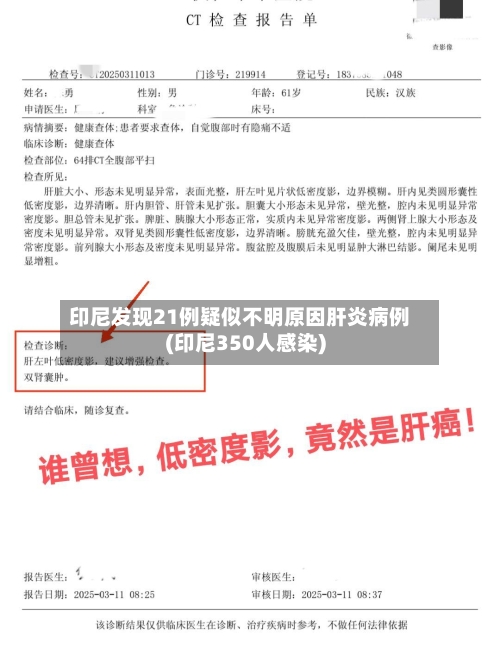 印尼发现21例疑似不明原因肝炎病例(印尼350人感染)-第2张图片